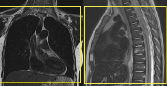 Thorax: enbart tra
